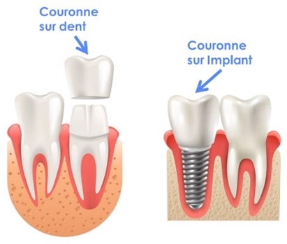 couronne_ou_implant