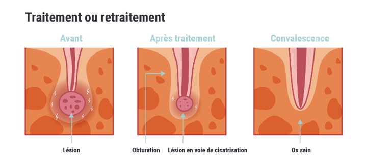 traitement_ou_retraitement