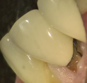 trauma_dent
