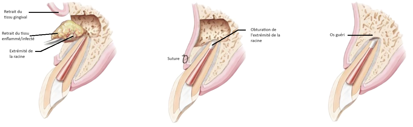 chirurgie-endodontique-apectomie