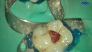 traitement-endodontique-initial-diagnostic-obturation