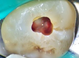 traitement-endodontique-initial-diagnostic-obturation-22112025
